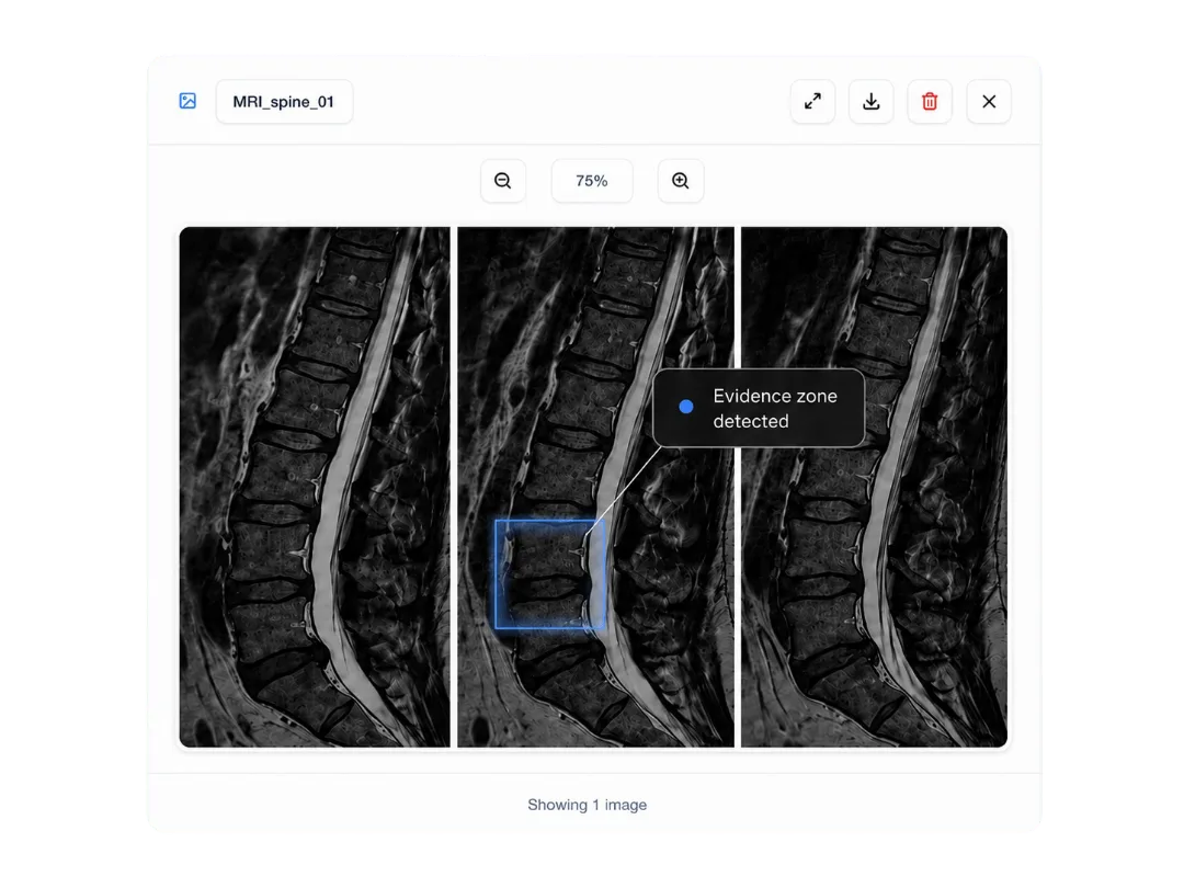 Avicen radiography viewer highlighting evidence on a medical image Avicen radiography viewer highlighting evidence on a medical image